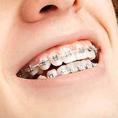 Ortodoncia clásica con brakets metálicos y ligaduras de goma