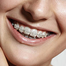 Ortodoncia realizada con brakets de zafiro o cerámico